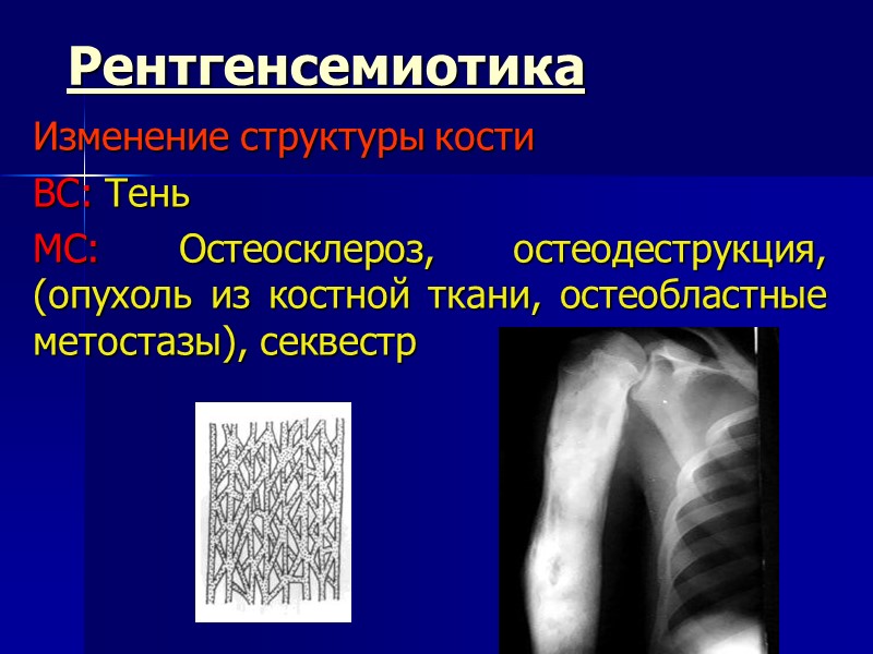 Рентгенсемиотика Изменение структуры кости ВС: Тень МС: Остеосклероз, остеодеструкция, (опухоль из костной ткани, остеобластные